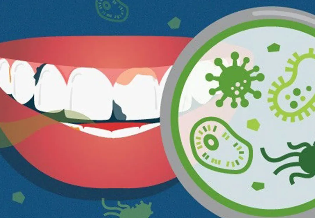Poor Oral Health Linked to Increased S.troke Risk