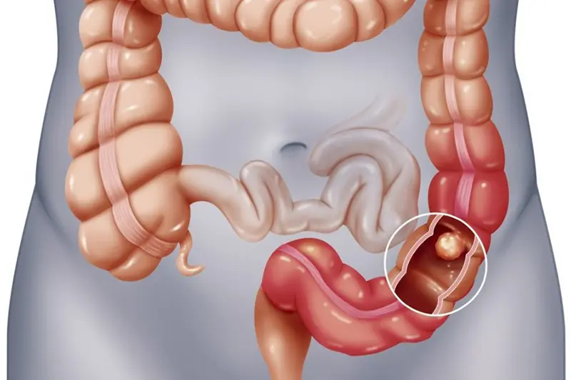 5 signs to help detect colitis early, the first signs of which are often overlooked