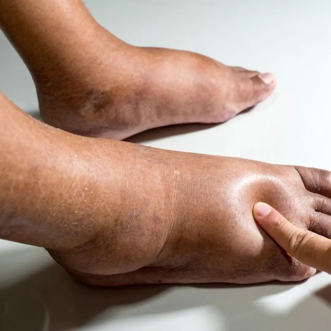 Foods that can ease swelling in hands and feet