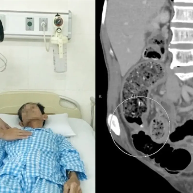 Doctors Reveal the Cause: Ignoring His Constipation Symptoms Cost a 41-Year-Old Man His Life in Just One Month