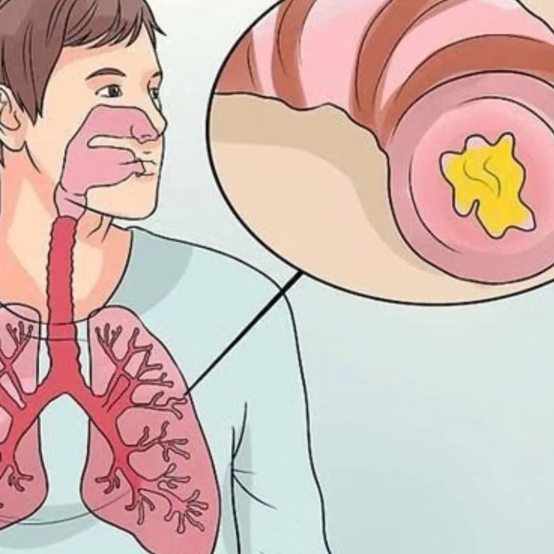 Symptoms of chronic bronchitis and treatment