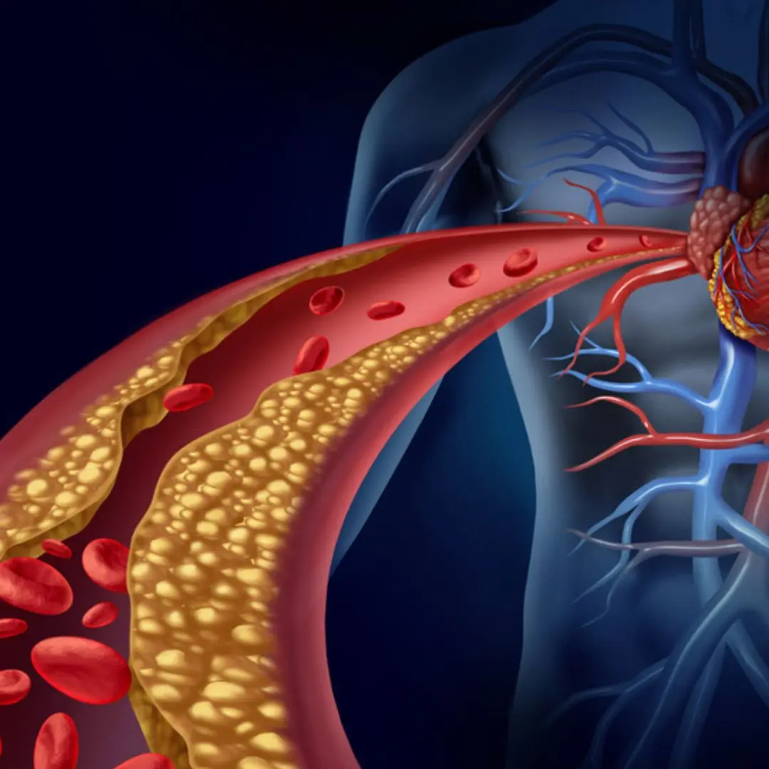 Your Body May Be Telling You Your Arteries Are Clogged — 10 Signs to Know