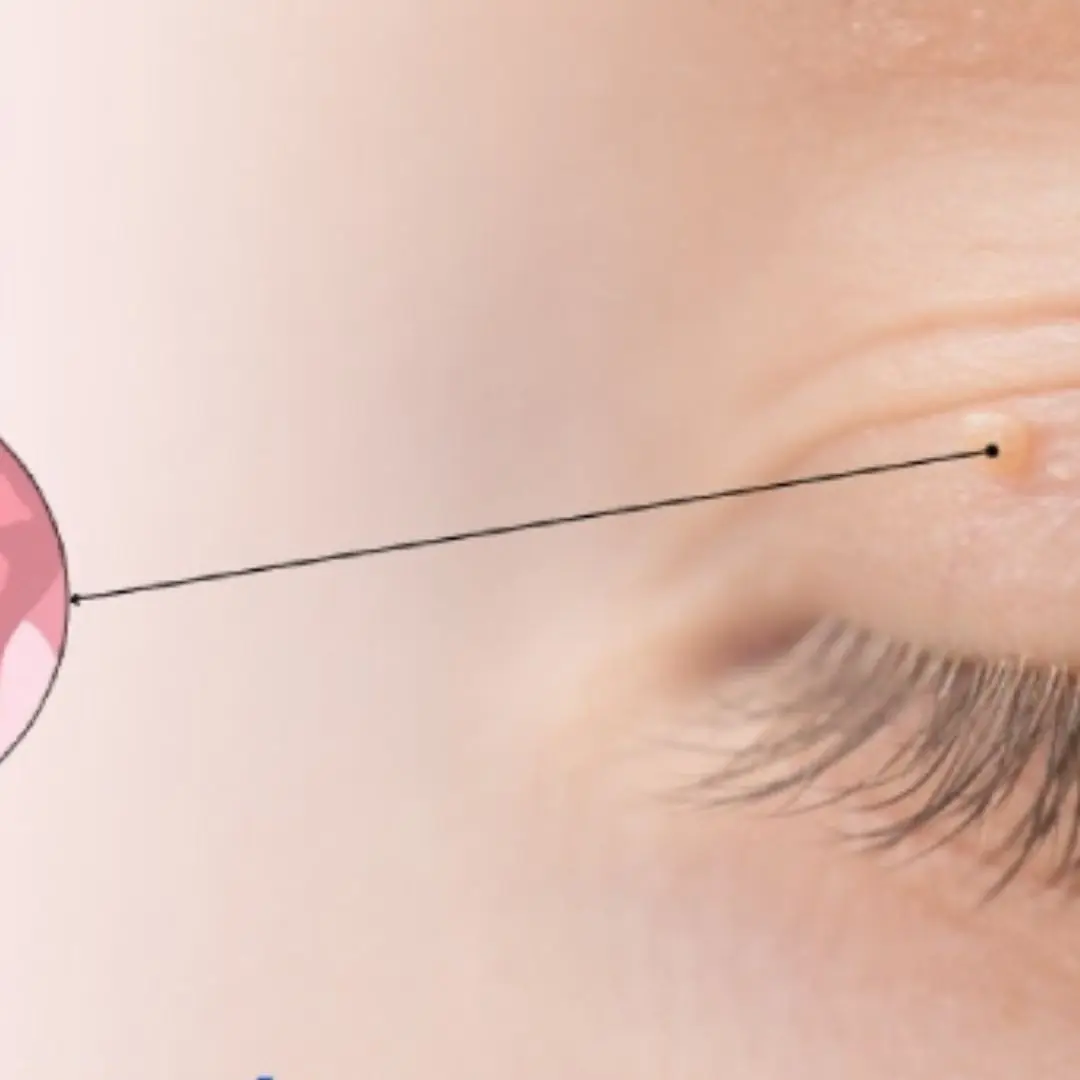 Do You Have Little White Bumps by Your Eyes? Learn What Milia Means for Your Skin