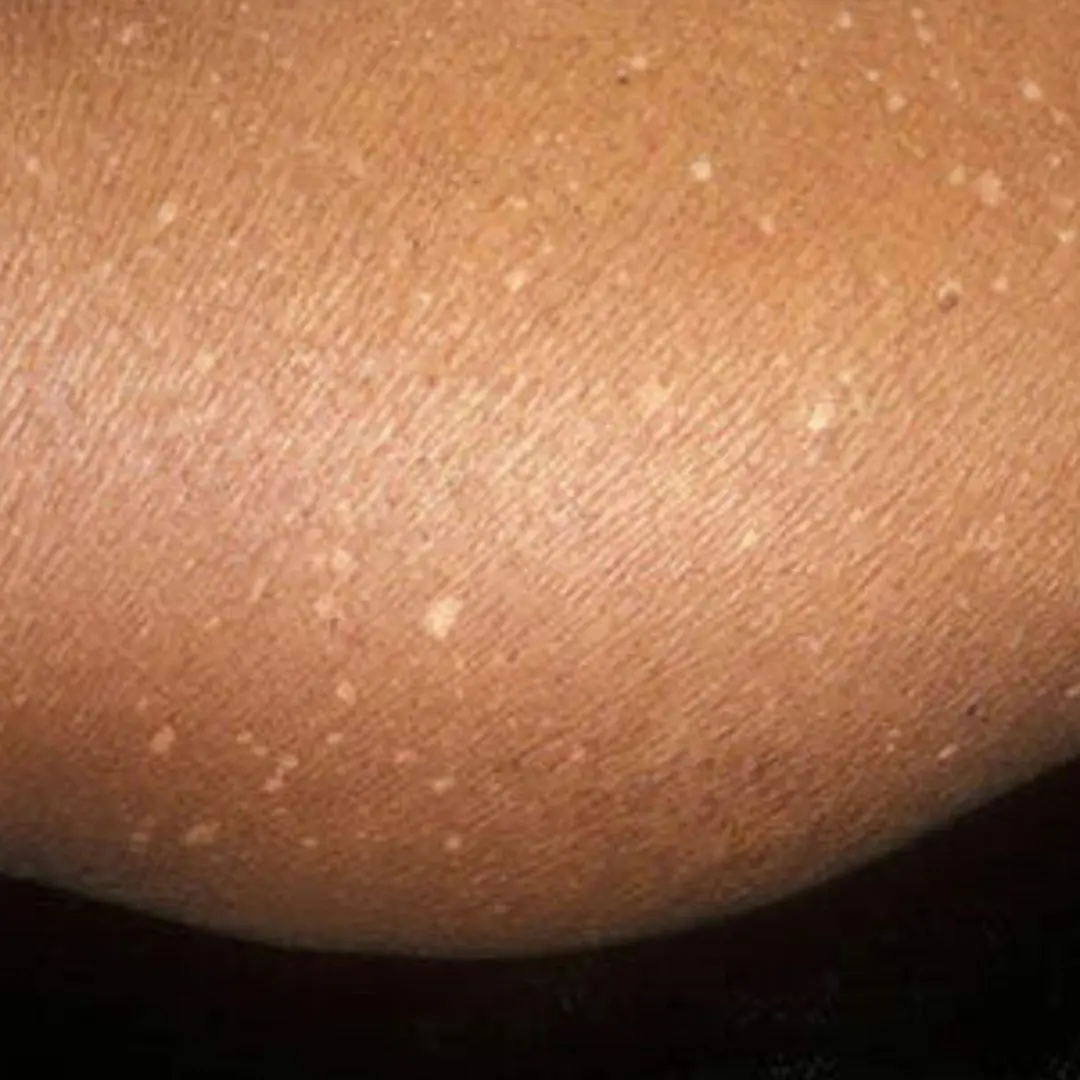 What Vitamin Deficiencies Can Cause White Spots on the Skin!