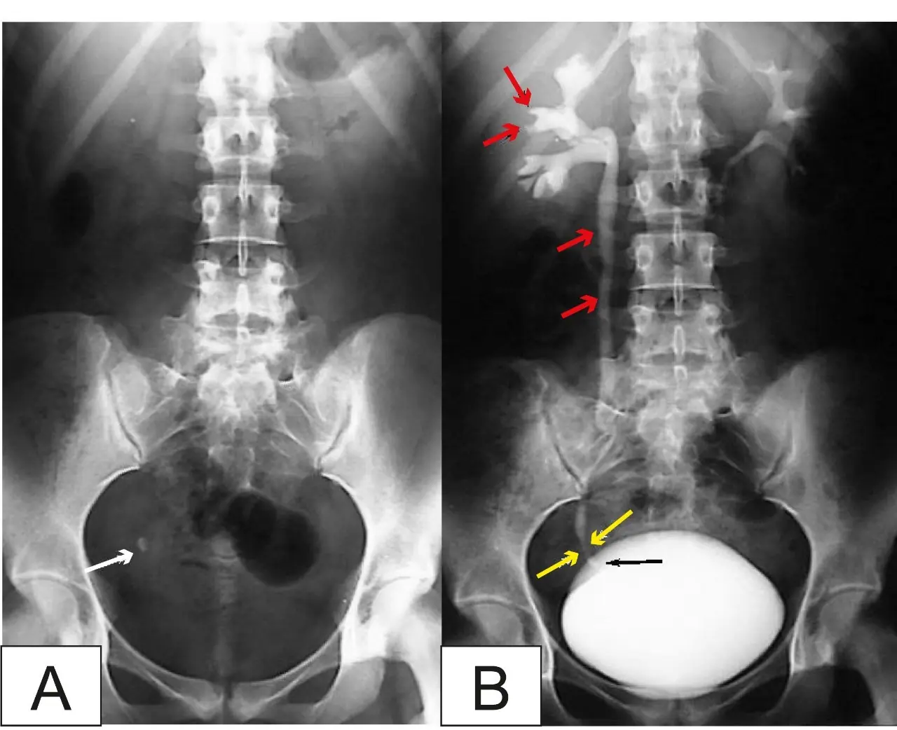40-year-old mother forced to undergo hysterectomy due to can.cer; her third-grade daughter has already started menst.ruating: Doctors point to the “culprit” in everyday food