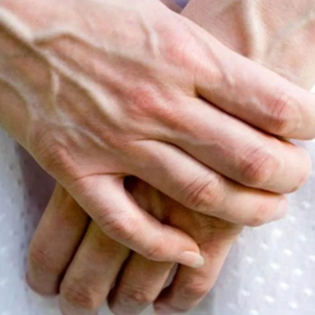 Seeing someone with bulging veins? They need to hear this immediately!