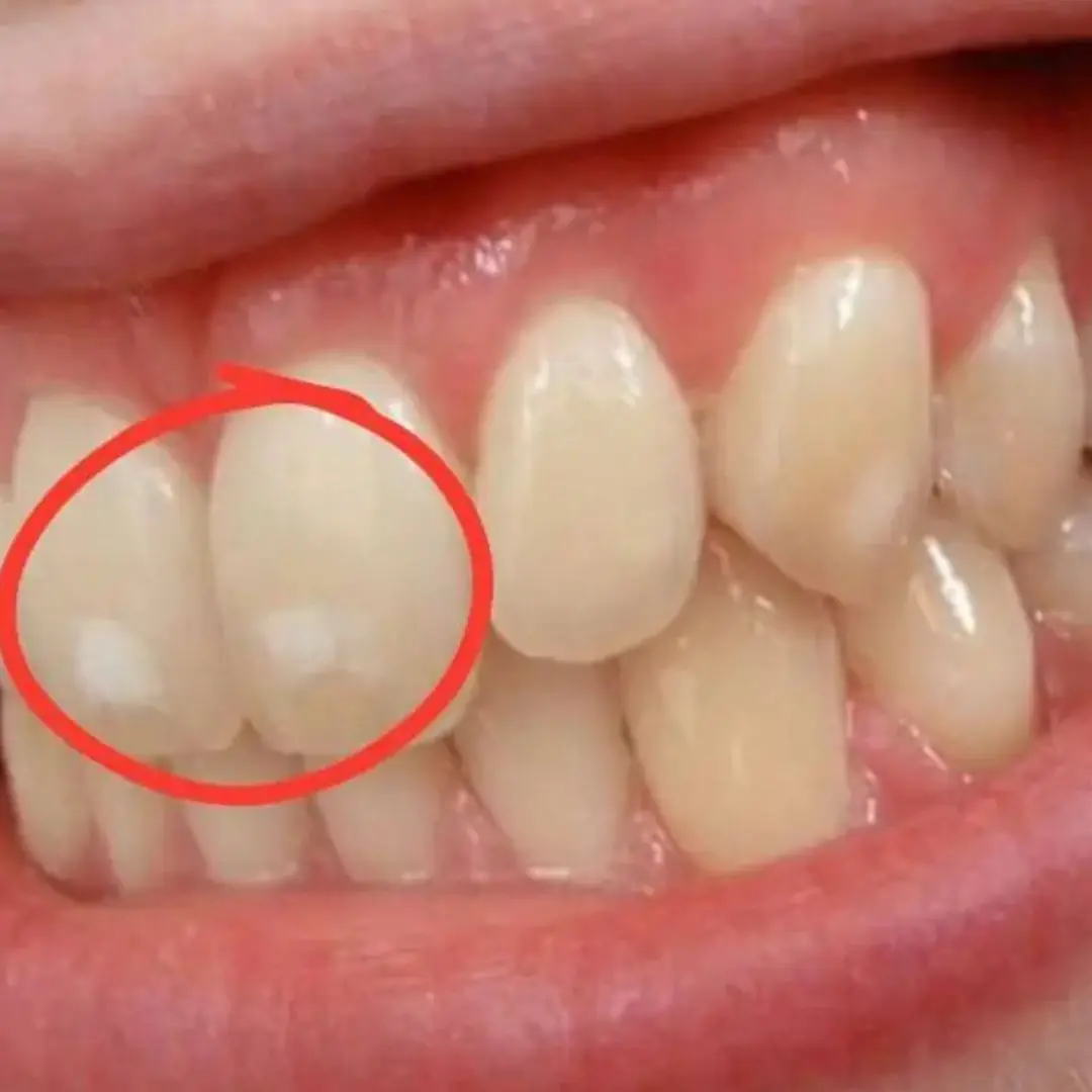 Your Teeth Are Sending You a Warning - White Spots Mean It's Time to Visit the Dentist