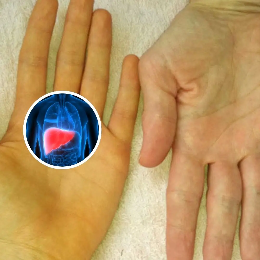 3 Strange Hand Symptoms That May Signal Liver Can.cer
