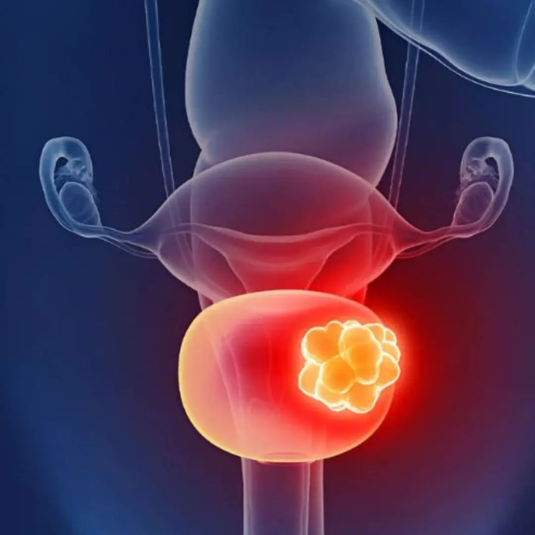 Early Warning Signs of Bladder Ca.n.cer