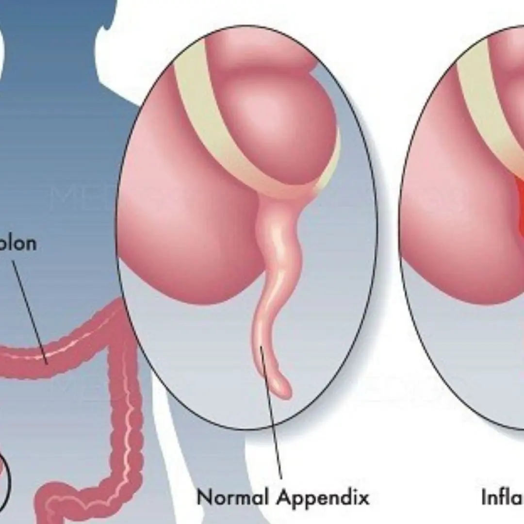 5 warning signs of appen:dicitis you should never ignore!