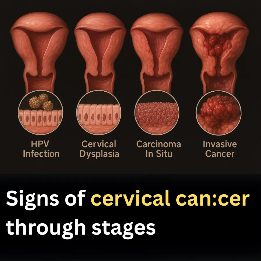 Signs of cervical can:cer through stages