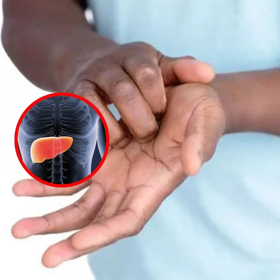 People with liver failure often have 3 characteristics on their hands, if you have 1 you should see a doctor soon.