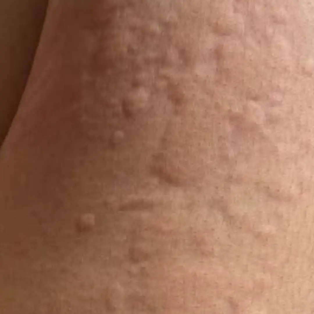 Her Whole Body Was Itchy: What She Thought Was a Common Allergy Was Hiding Something More Serious