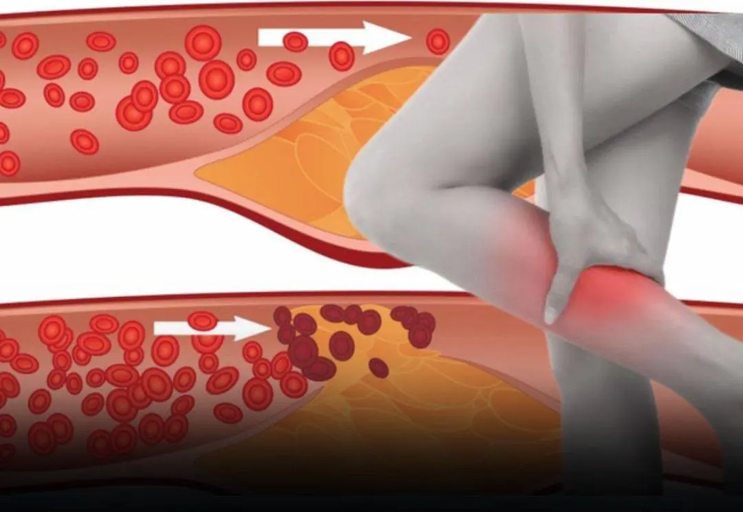 Few people recognize the warning signs of circulation problems that may appear in the feet and legs at night