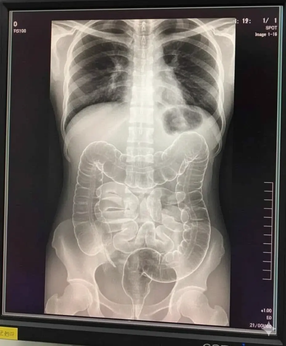 The X-ray of a Young Woman’s Struggle with Ch.ronic Constipation