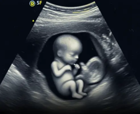 Scientists May Have Actually Found One Of The Causes Of Autism