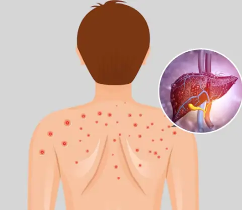 Fatty Liver: Causes, Symptoms, Treatment & Home Remedies