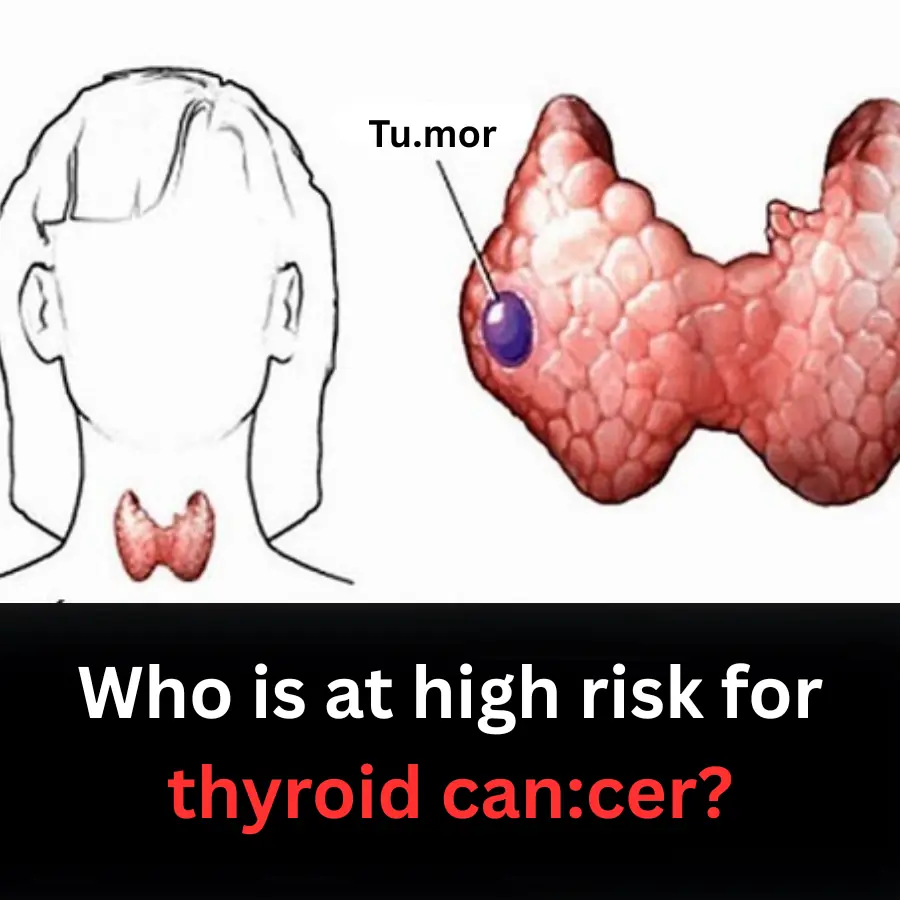 Who is at high risk for thyroid can:cer?