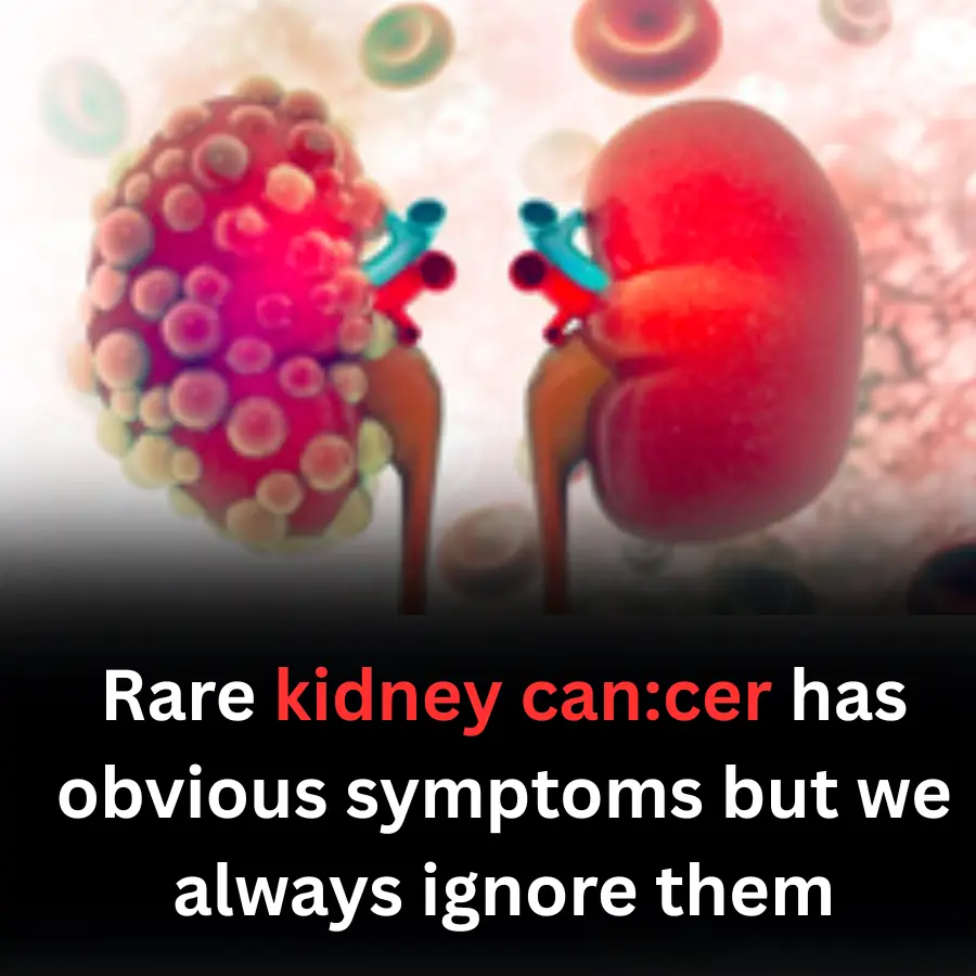 Rare kidney can:cer has obvious symptoms but we always ignore them