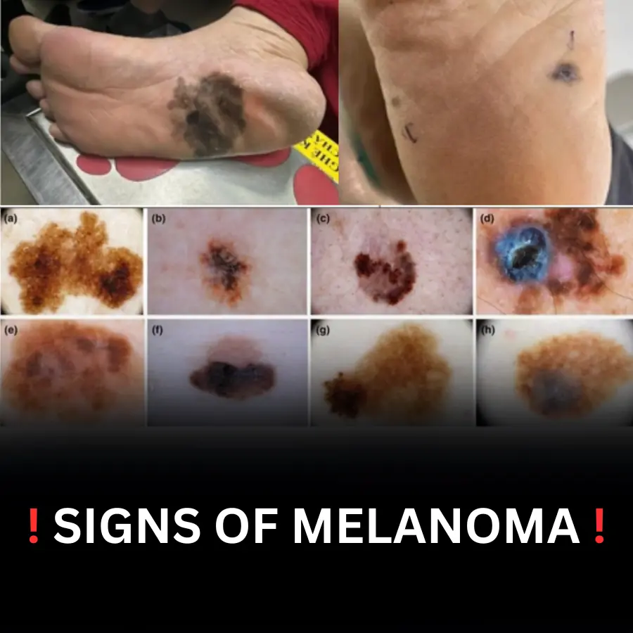SIGNS OF MELANOMA !