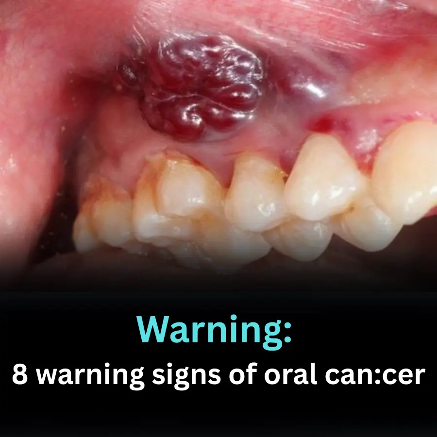 8 warning signs of oral can:cer
