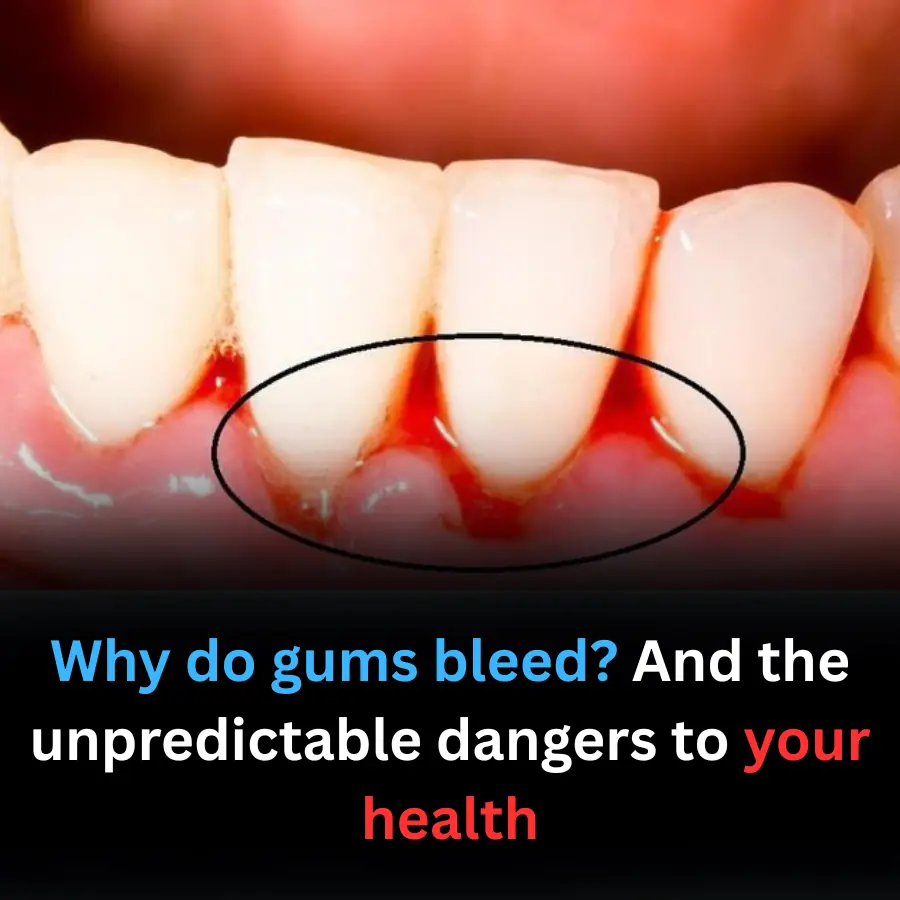 Why do gums bleed? And the unpredictable dangers to your health