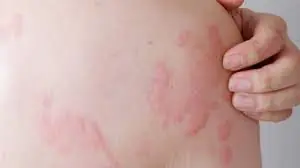 Two it.chy body parts may signal liver can.cer - Many people mistakenly think it is an all.ergy