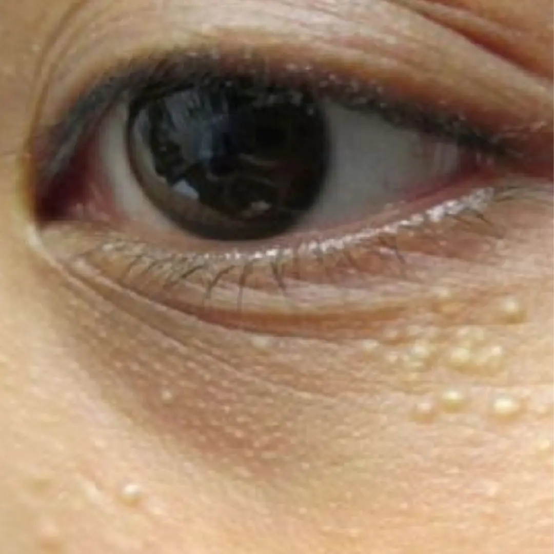 White Spots Under the Eyes? Here’s What Milia Really Is — Causes, Risks, and the Treatments That Actually Work