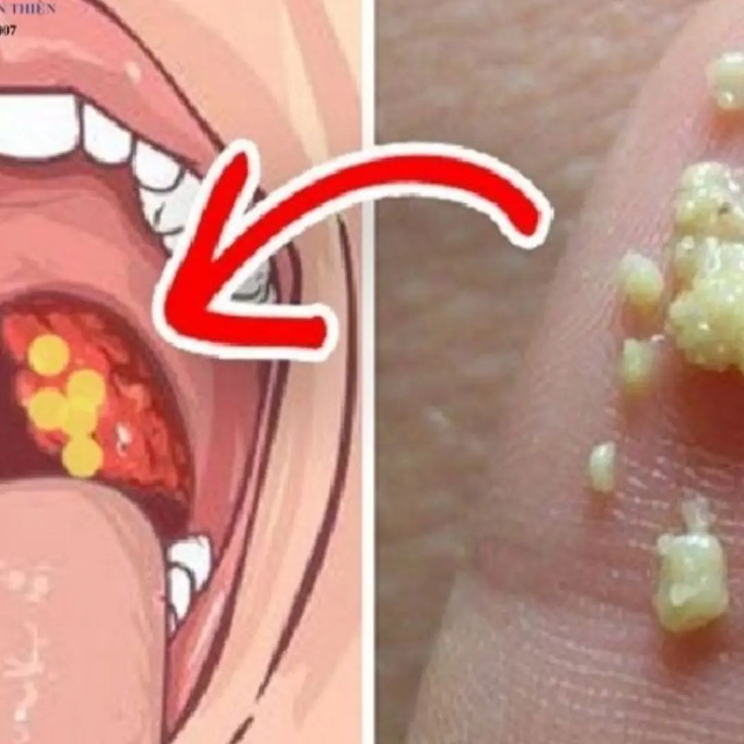 If your tonsils have white spots, you may have an infection...
