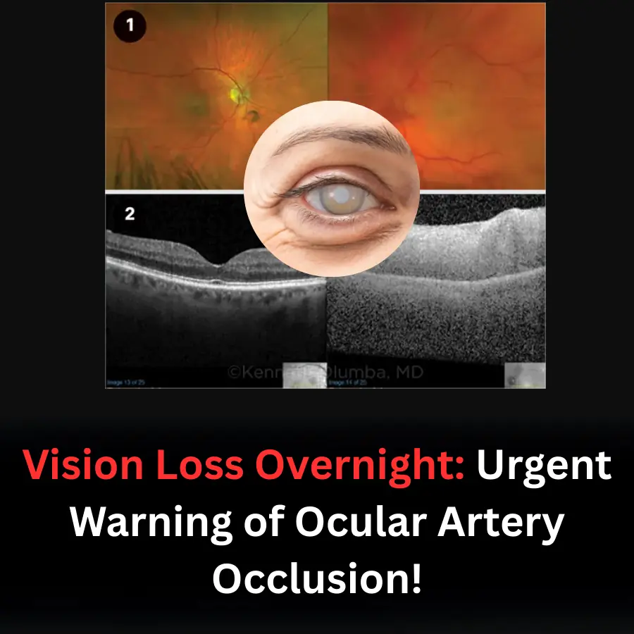 Vision Loss Overnight: Urgent Warning of Ocular Artery Occlusion!