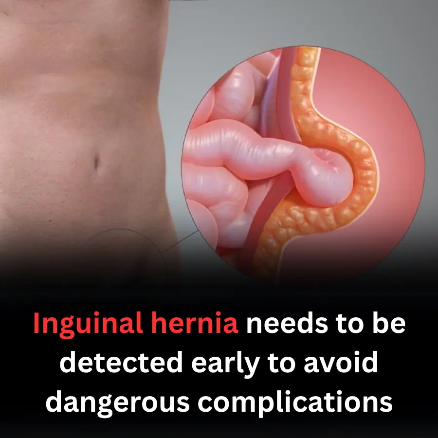 Inguinal hernia needs to be detected early to avoid dangerous complications