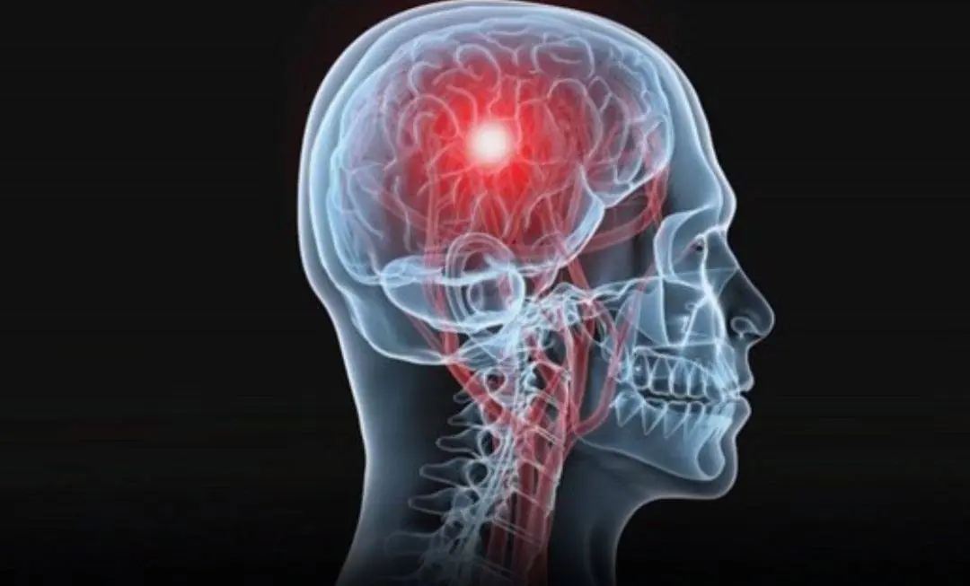 Stroke symptoms can sometimes appear suddenly during rest. If you notice unusual nighttime neurological signs, seek medical attention immediately instead of trying to go back to sleep.