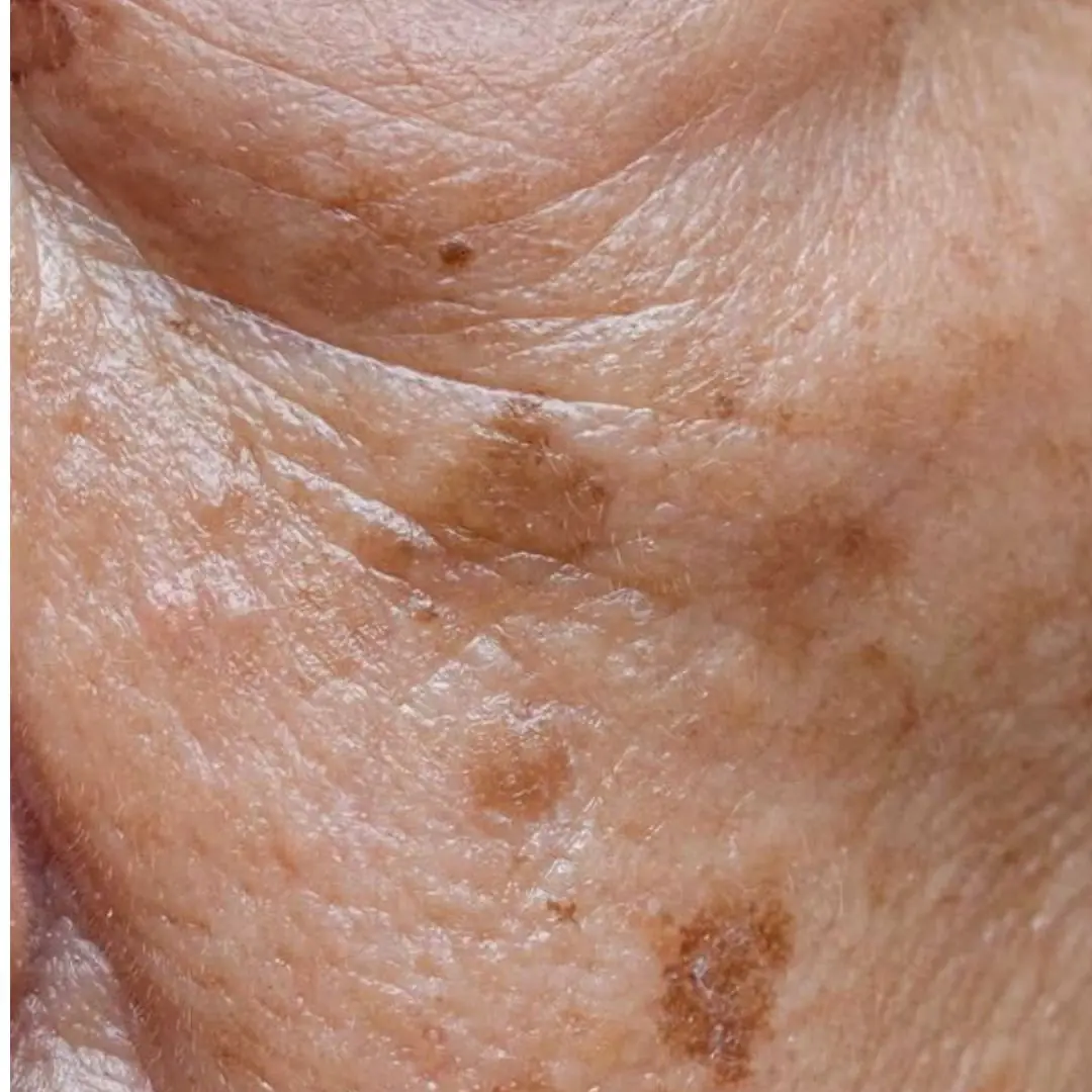 Age Spots and Selenium: How This Powerful Mineral Can Help Fight Sun Damage Naturally