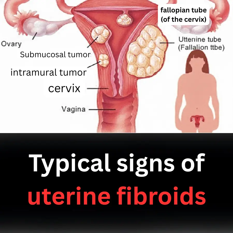 Typical signs of uterine fibroids
