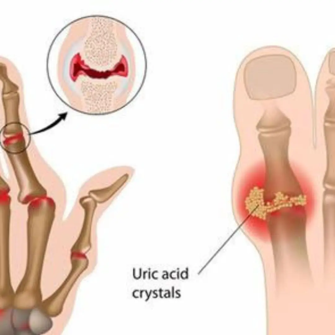 The #1 Drink to Reverse High Uric Acid and Gout — Backed by Science