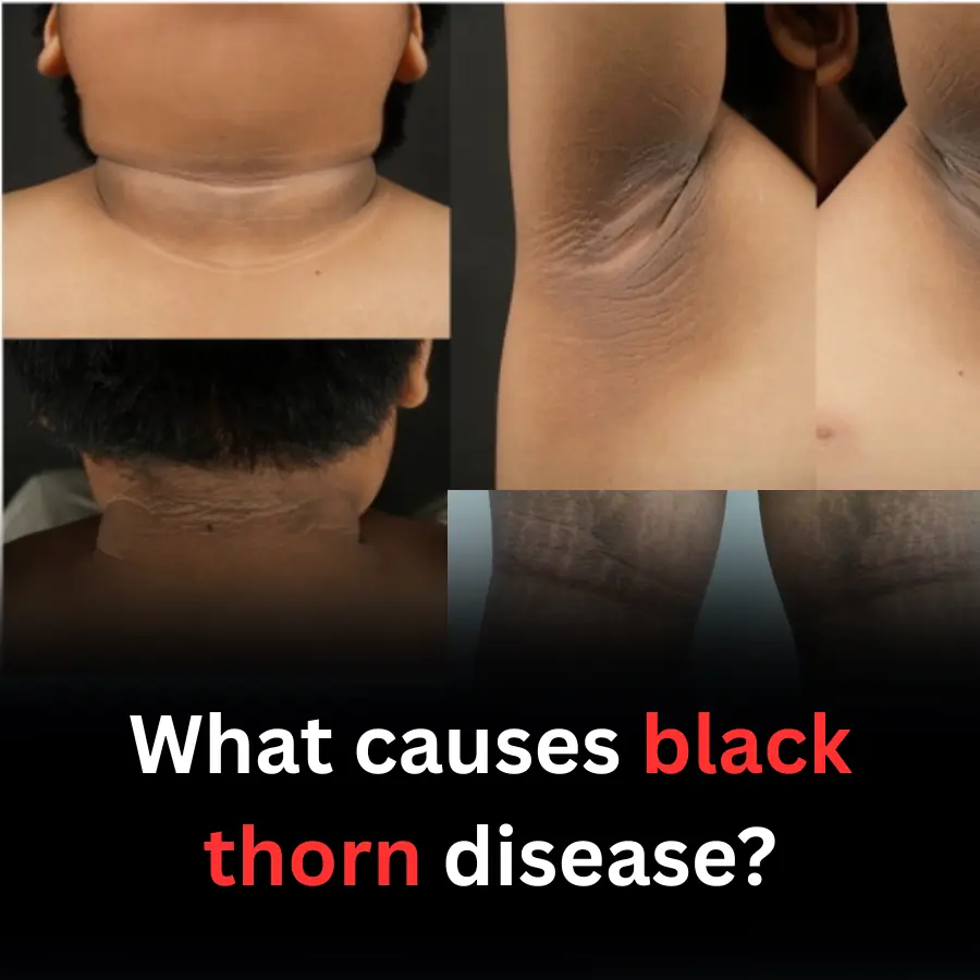 What causes black thorn disease?