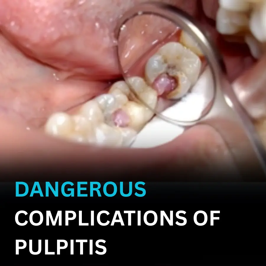 DANGEROUS COMPLICATIONS OF PULPITIS