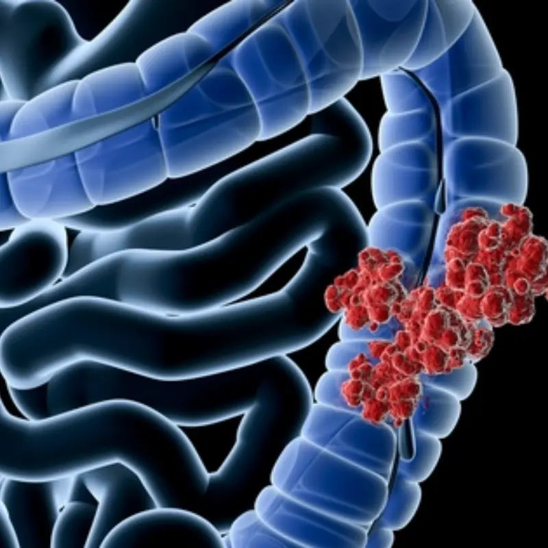 To Prevent Colon Can.cer, This Is the First Thing You Need to Do