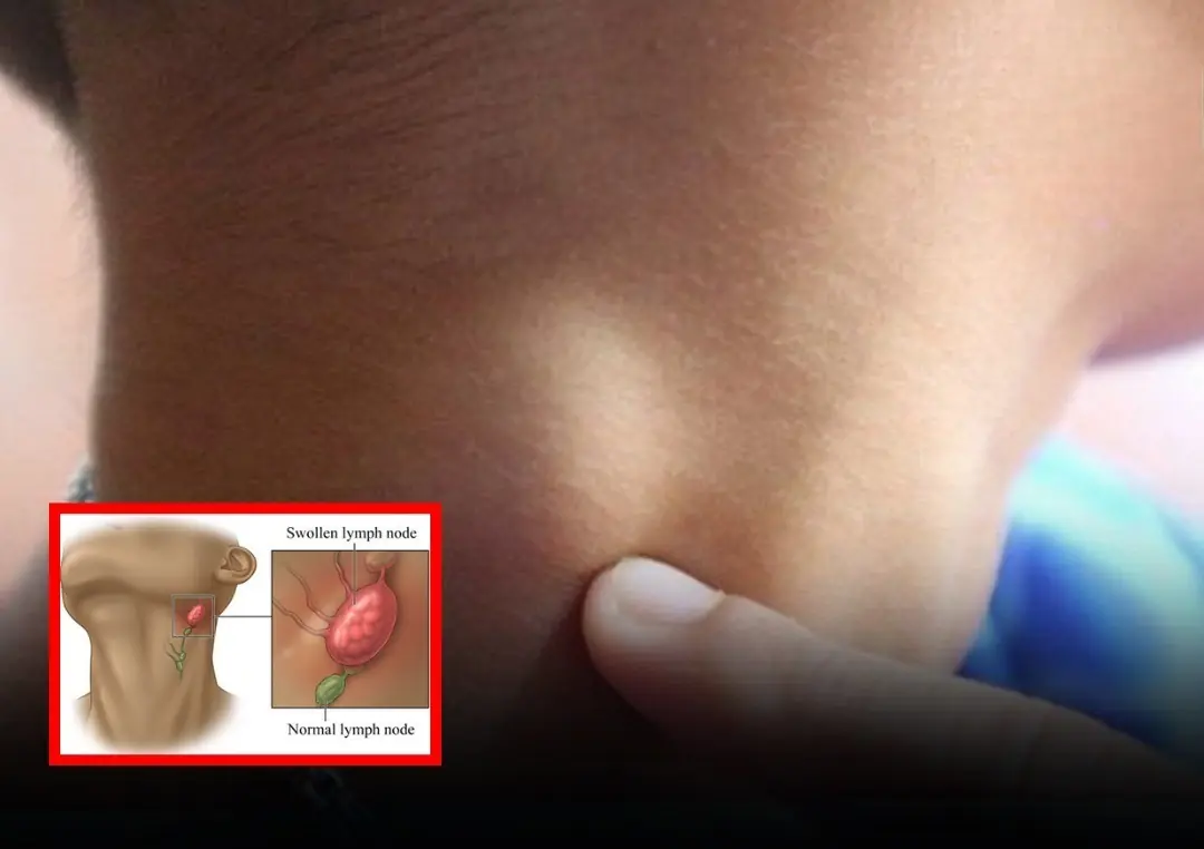 Ne.ck Swe.lling and Lymph No.des: Know When It’s Time to Act