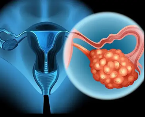 8 Early Warning Signs Of Ovarian Cancer You Shouldn’t Ignore