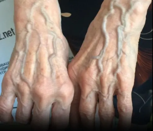 Why Are My Veins Suddenly Bulging and Visible?