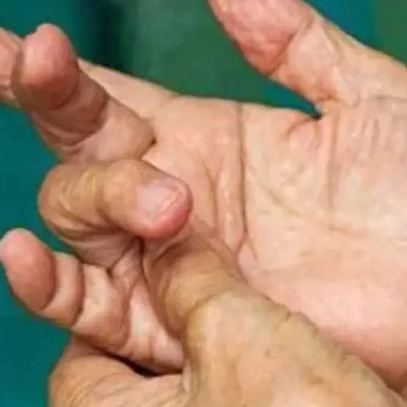 4 Finger Changes That May Signal Lung Can.cer — See a Doctor Immediately