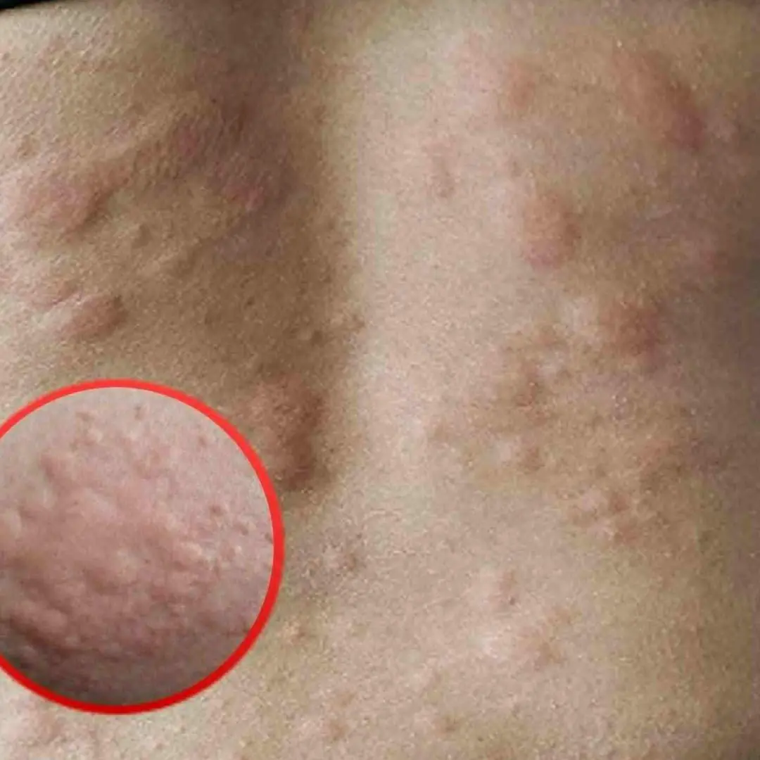 His whole body was itchy, he thought it was an allergy but then he was diagnosed