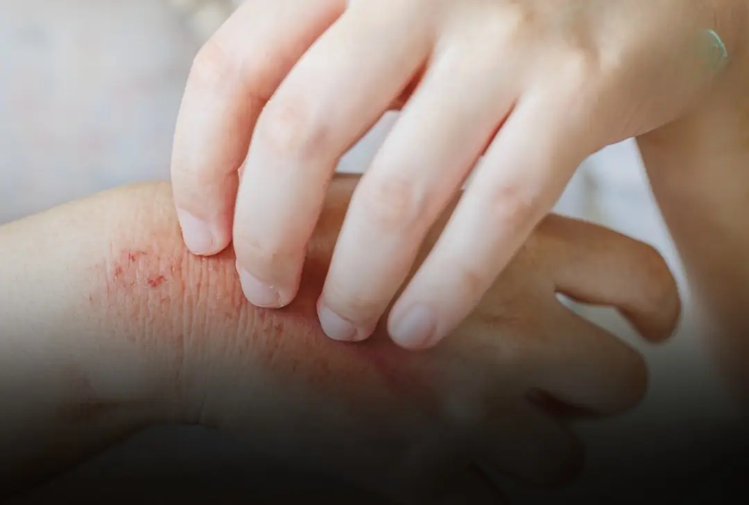 Surprising causes of hives revealed - What may be triggering your skin