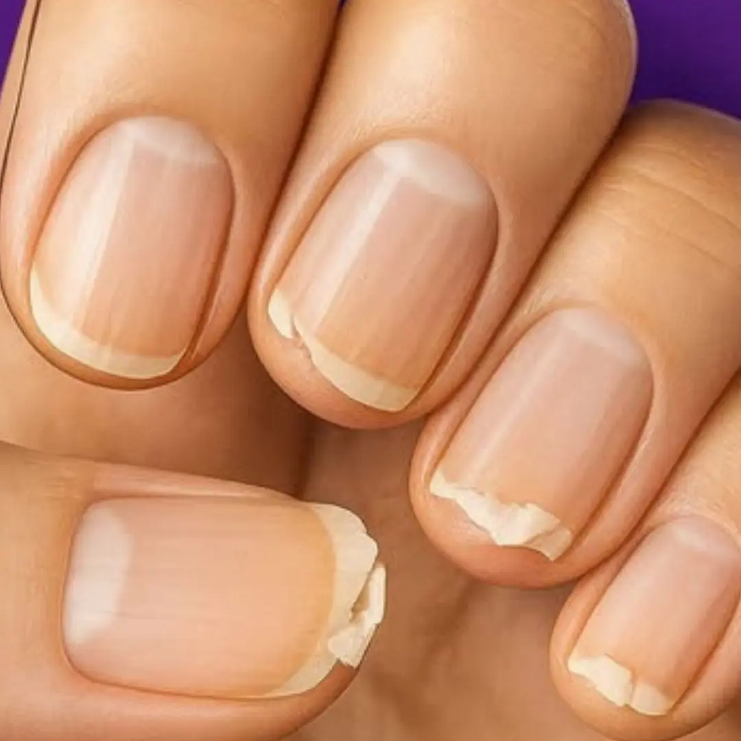 Are your nails constantly splitting or breaking? Your body might be sending you a warning — and the reason may surprise you!