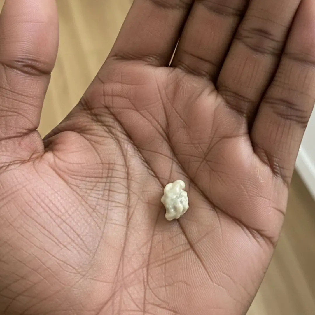 Here’s what you need to know about tonsil stones – the weird pimple-like growths in your throat