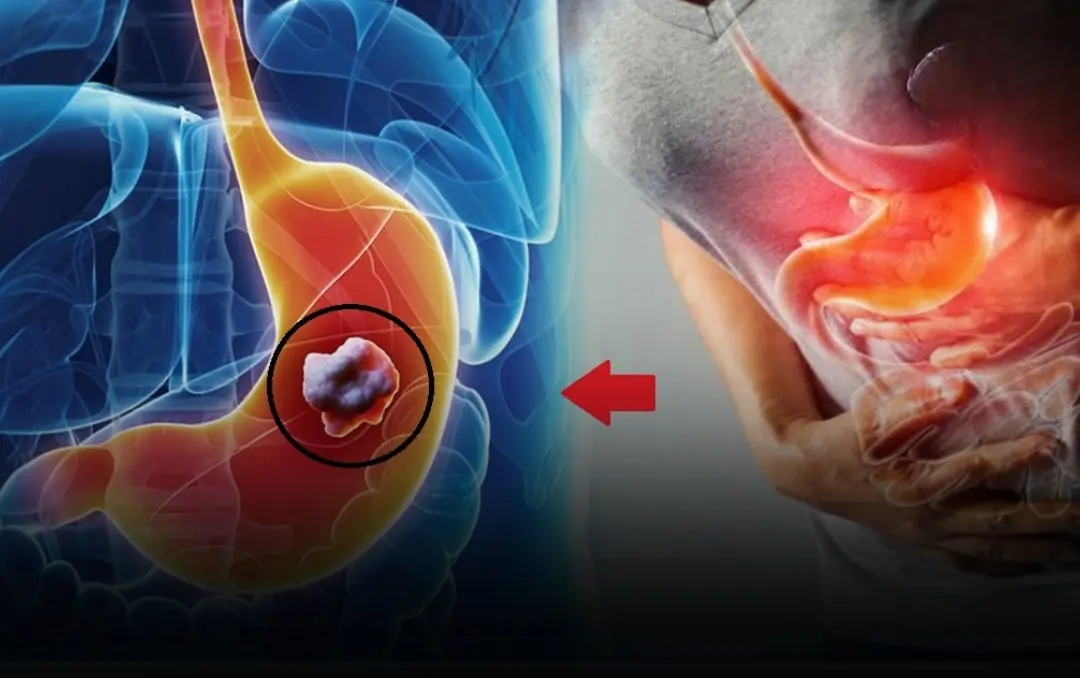 7 Silent Symptoms Showing Your Stomach Can:cer May Be in Its Final Stages