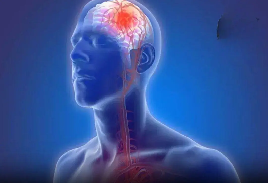 S.tro.ke warning signs can appear as early as 90 days prior to the event