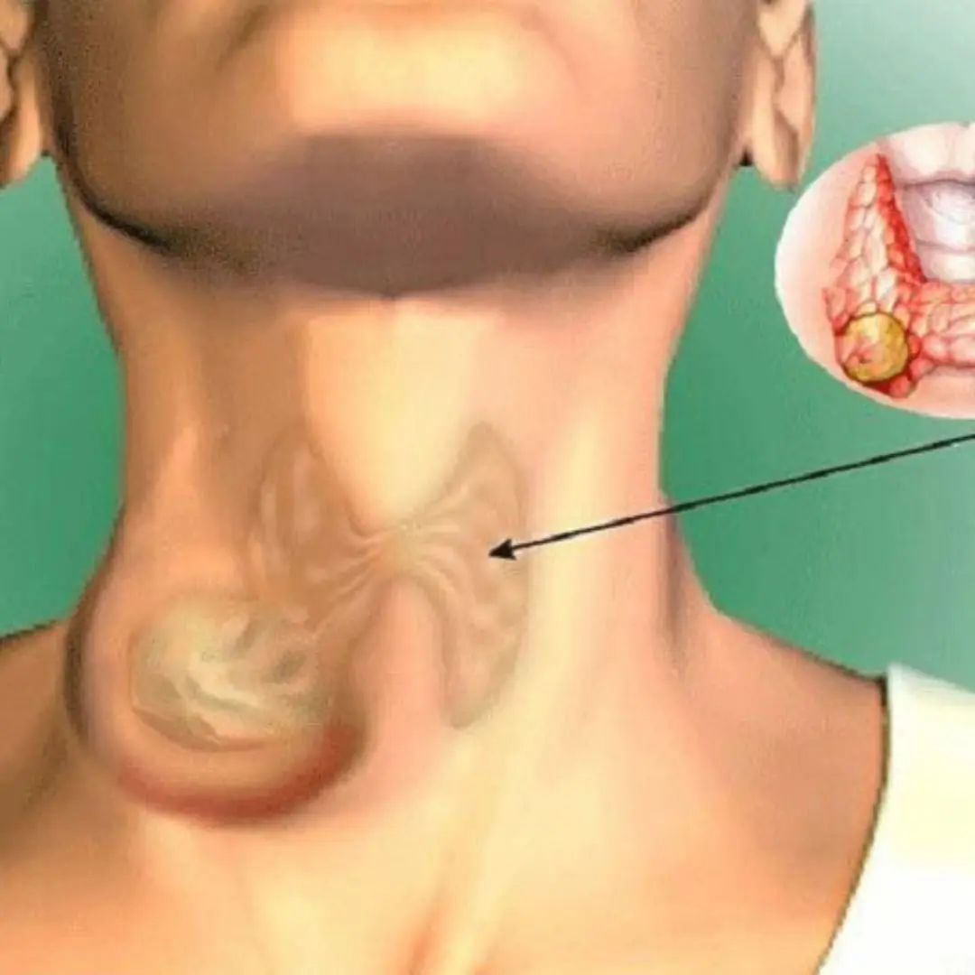 Should People with Thyroid Problems Avoid Soy? Warning: These 2 Supplements Could Accelerate Thyroid Ca.ncer