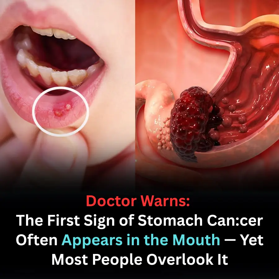 Doctor: The earliest sign of stomach cancer often appears in the mouth — but most people fail to notice it